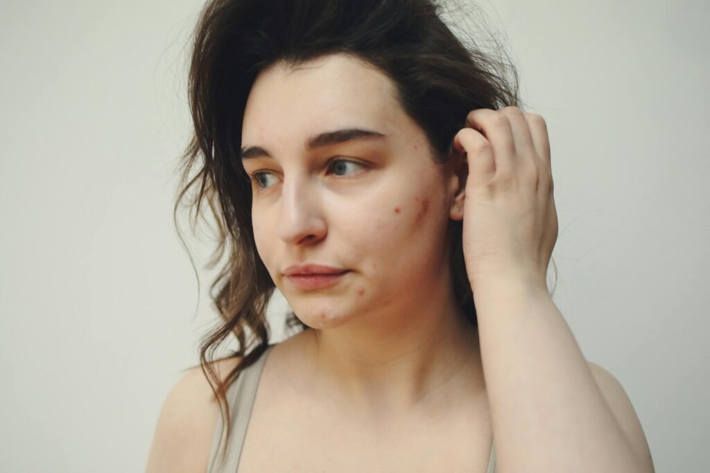 cure for hyperpigmentation