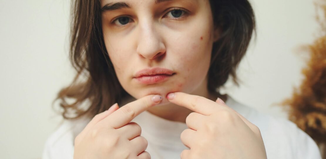 Best Treatment for Breakouts