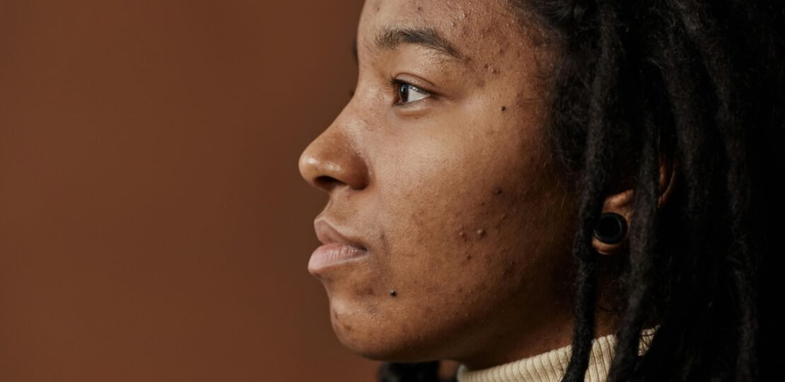 What is Hyperpigmentation: Causes and Treatments